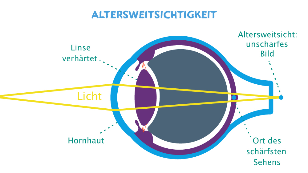 Bei der Altersweitsichtigkeit vermindert sich die Brechkraft der Linse.