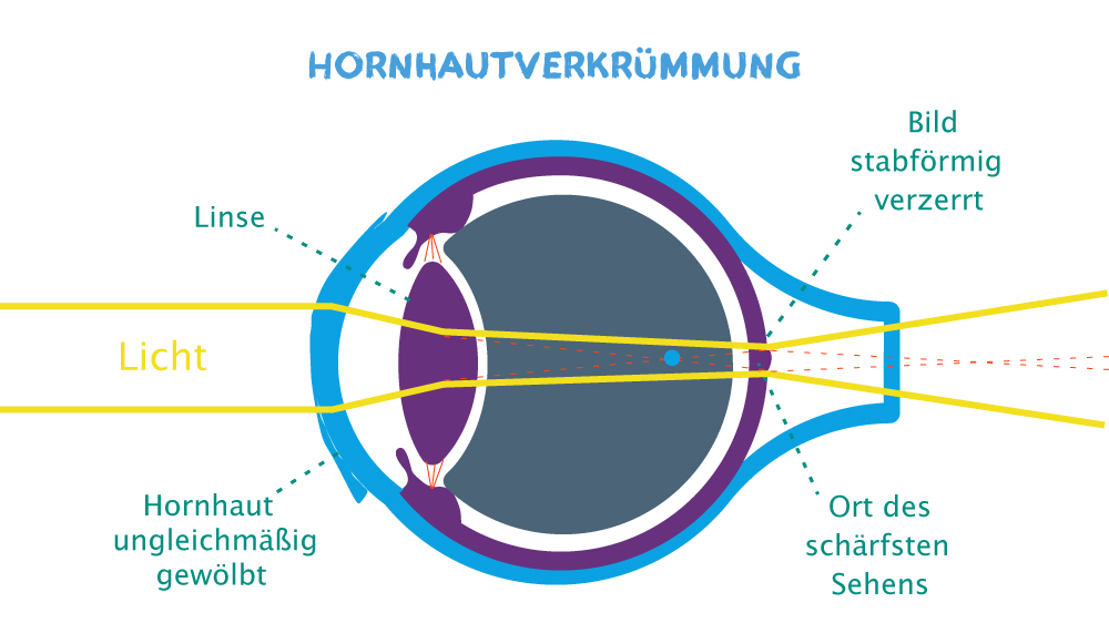 Bei der Hornhautverkrümmung wird das Bild stabförmig auf der Netzhaut abgebildet.